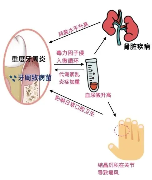健康视野嘴巴里的“腐腥气”，警惕牙周炎背后的代谢危机